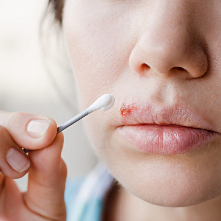 How to Quickly Get Rid of a Cold Sore We Prescribe