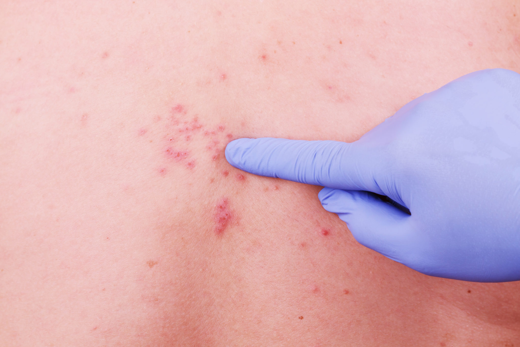 Viral Dermatitis Symptoms Treatment We Prescribe