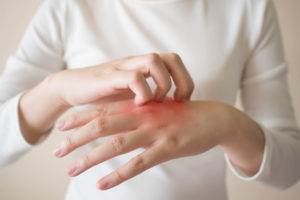Eczema Triggers and Irritants