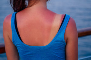 Best way to heal sunburn